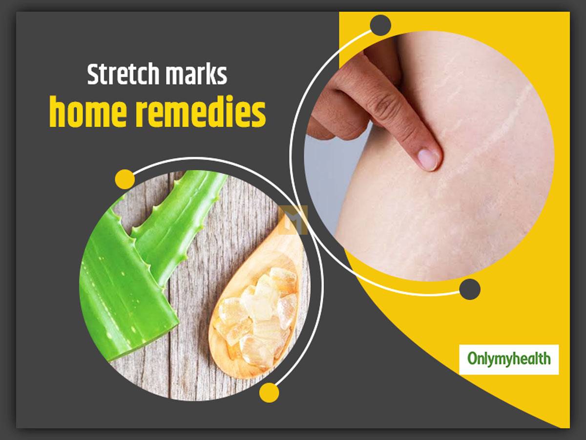 Home remedies for stretch marks