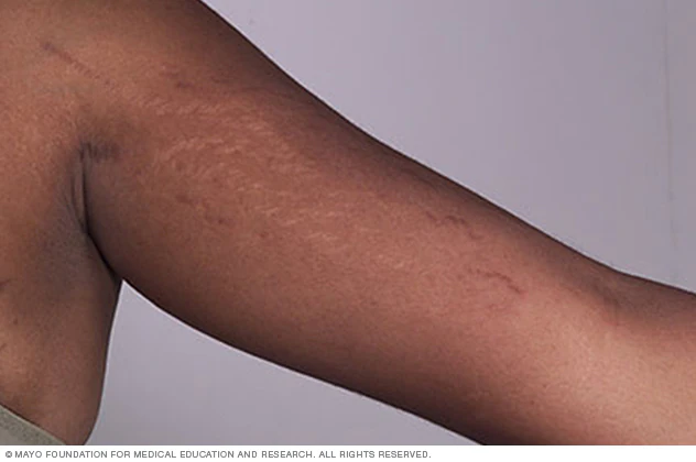 Stretch marks: why they occur and how to treat them?
