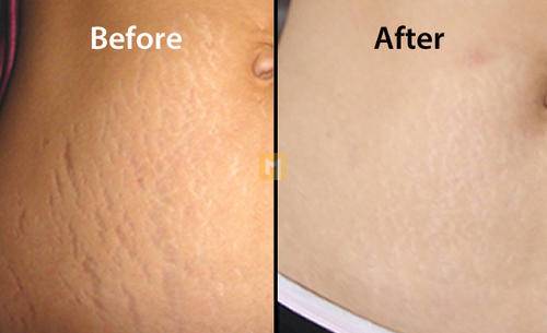 Stretch marks: why they occur and how to treat them?