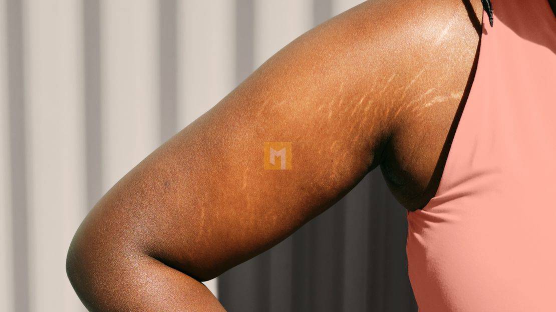 Stretch marks: why they occur and how to treat them?