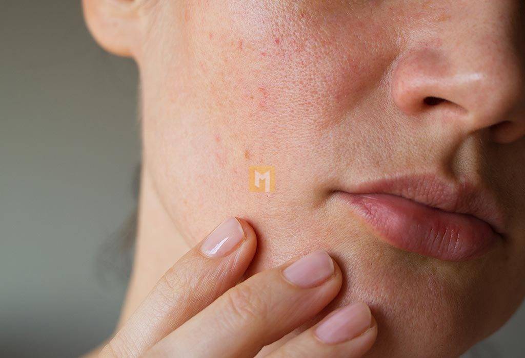 How to clear and prevent clogged pores