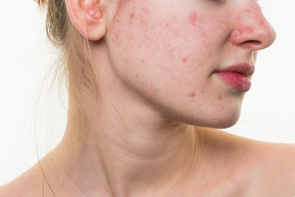 What to know about skin blemishes