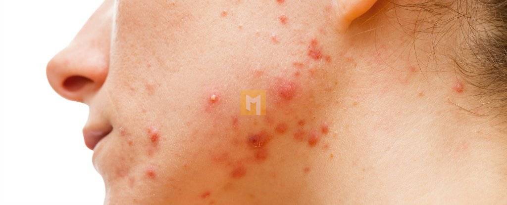 What causes pimples?