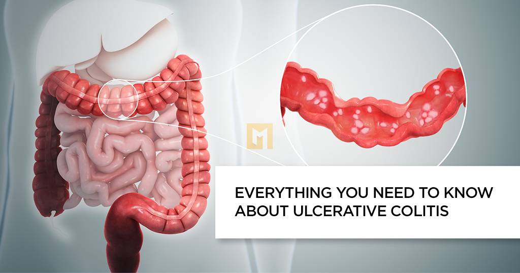 What to know about ulcerative colitis