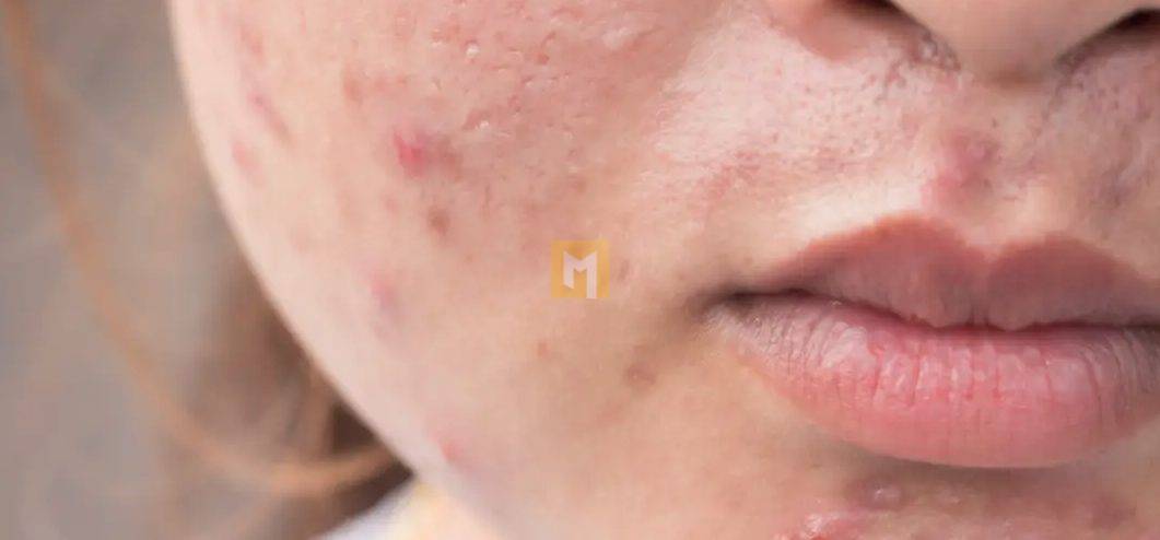 What to know about comedonal acne