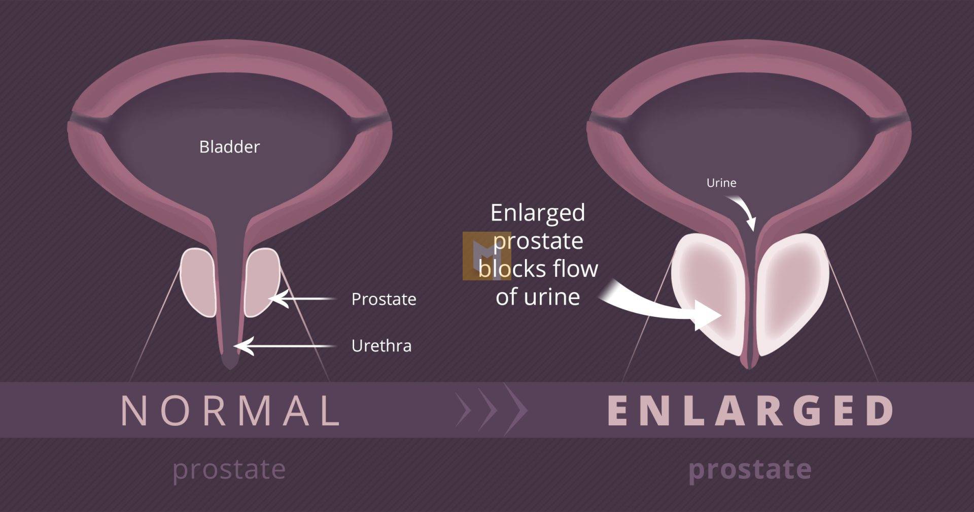 Benign Prostatic Hyperplasia: Enlargement of the Prostate Gland- Causes, Symptoms, Treatment