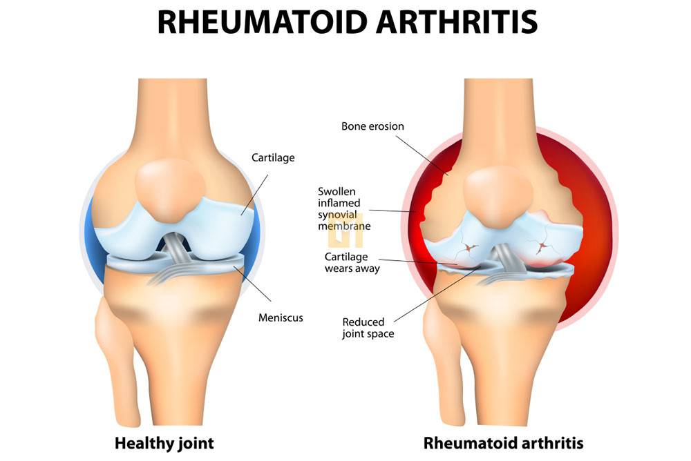 Autoimmune arthritis: Types, symptoms, and treatment