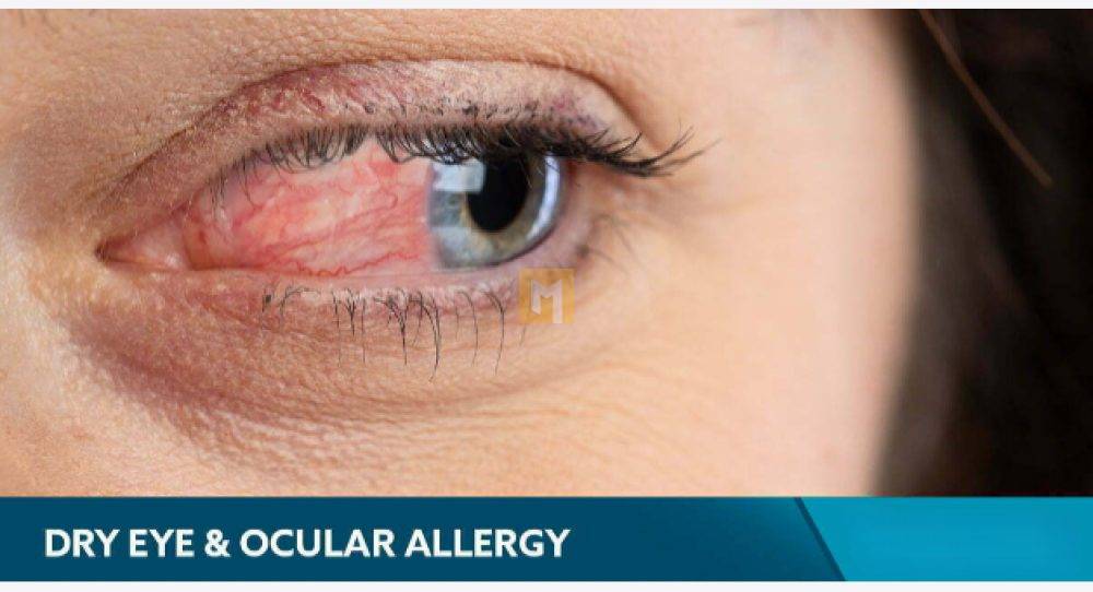 What to know about dry eyes due to allergies