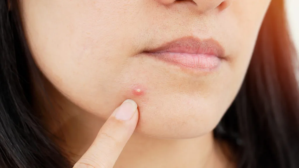 What to do when pimples do not go away
