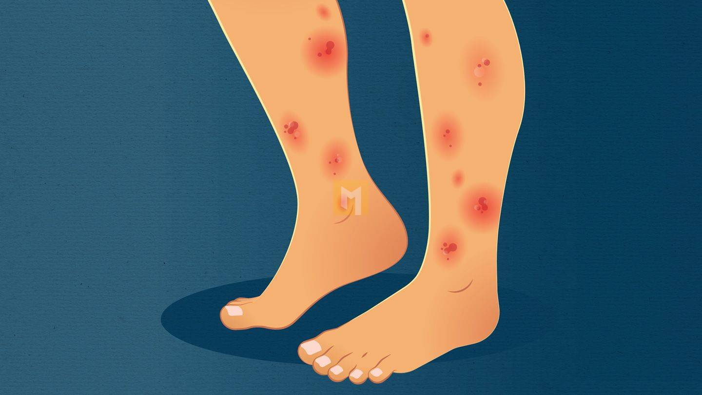 10 Rashes caused by ulcerative colitis