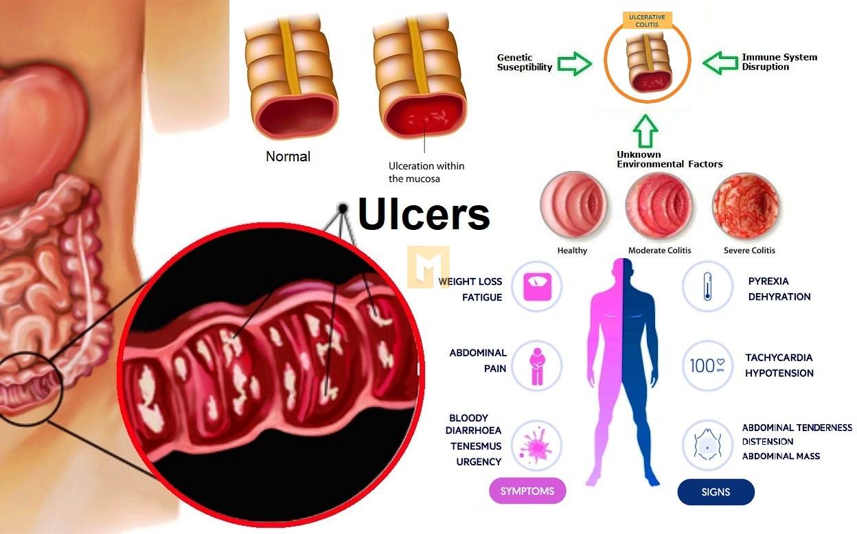 Ulcerative colitis: Treatment and pain relief